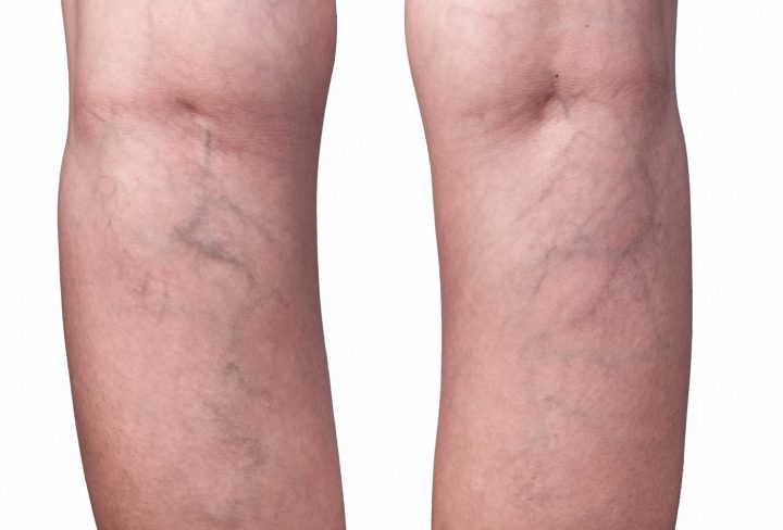 Deep Vein Thrombosis